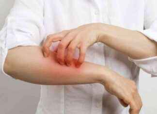 Rising Scabies Cases at Warrington Hospital: What You Need to Know news-10102024-104711