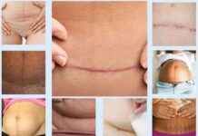 Free C-Section Scar Support and Therapy for New Moms in Warrington news-31102024-140755