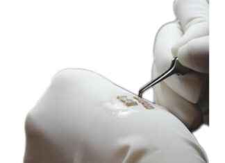 Essential Post-Operative Tips for a Successful Hair Transplant Recovery Essential Post-Operative Tips for a Successful Hair Transplant Recovery